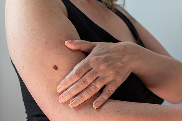 a womans arm with an abnormal mole