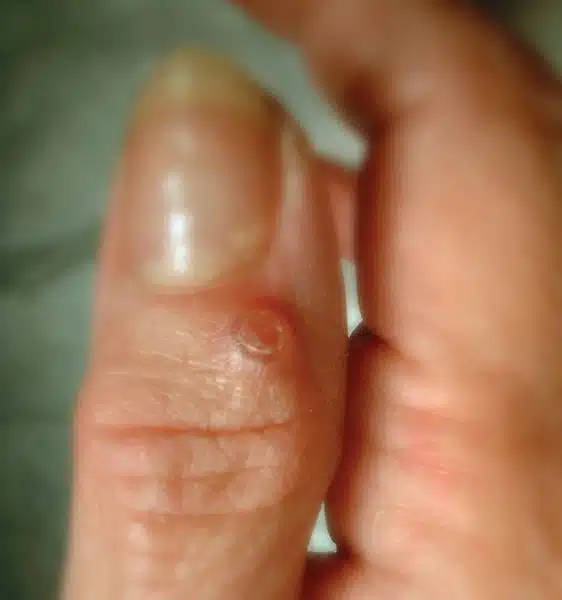 Ganglion cyst of the finger